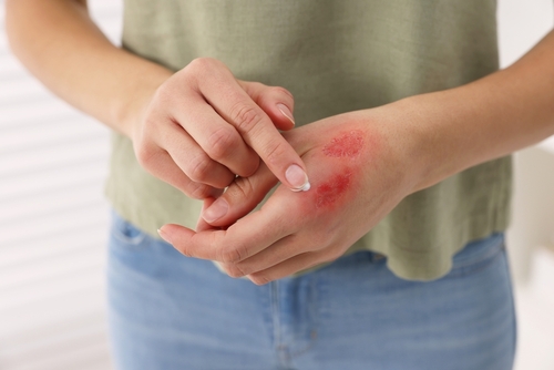 burn injury lawyer, Asheville burn injury lawyer, personal injury lawyer in Asheville.